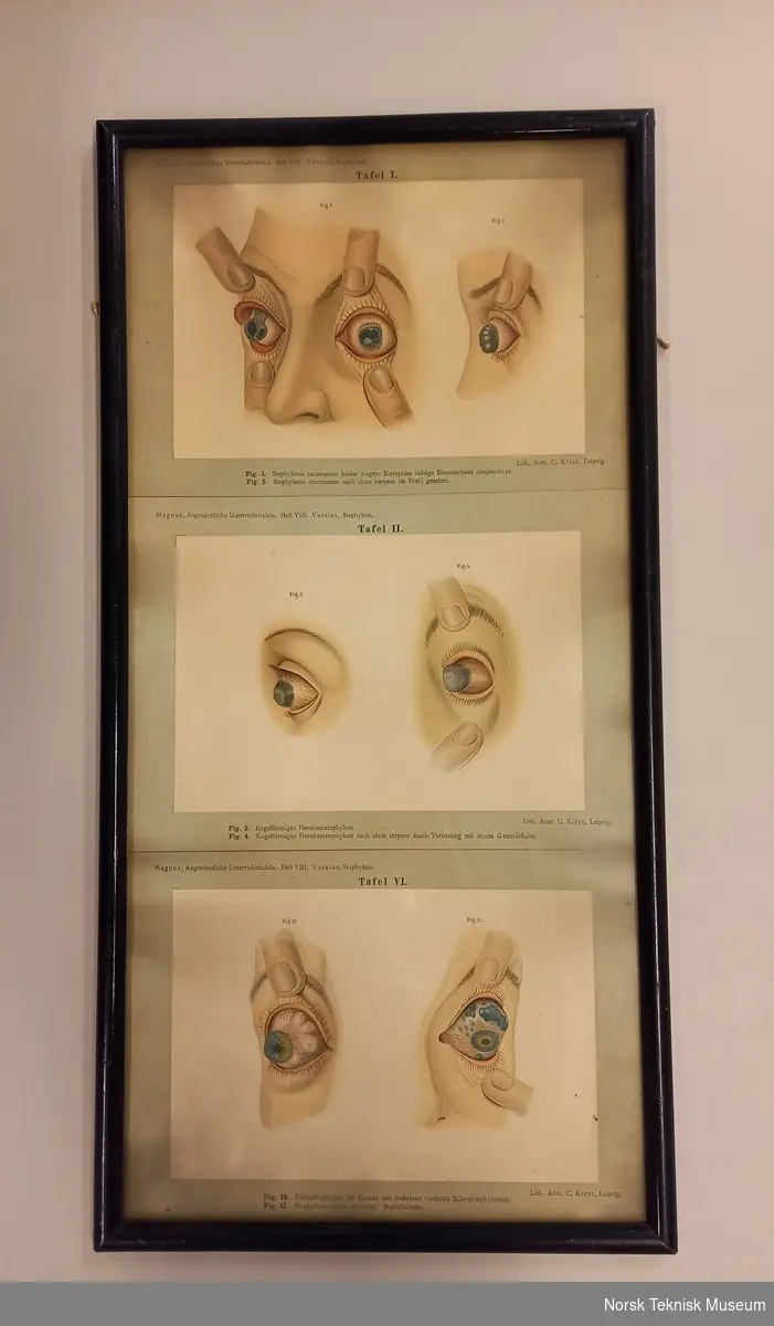 Tre plansjer i ramme viser ulike sykdommer på øyeeplet.