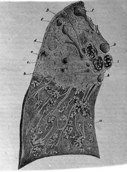 Lungetuberkulose. Fig. 66.