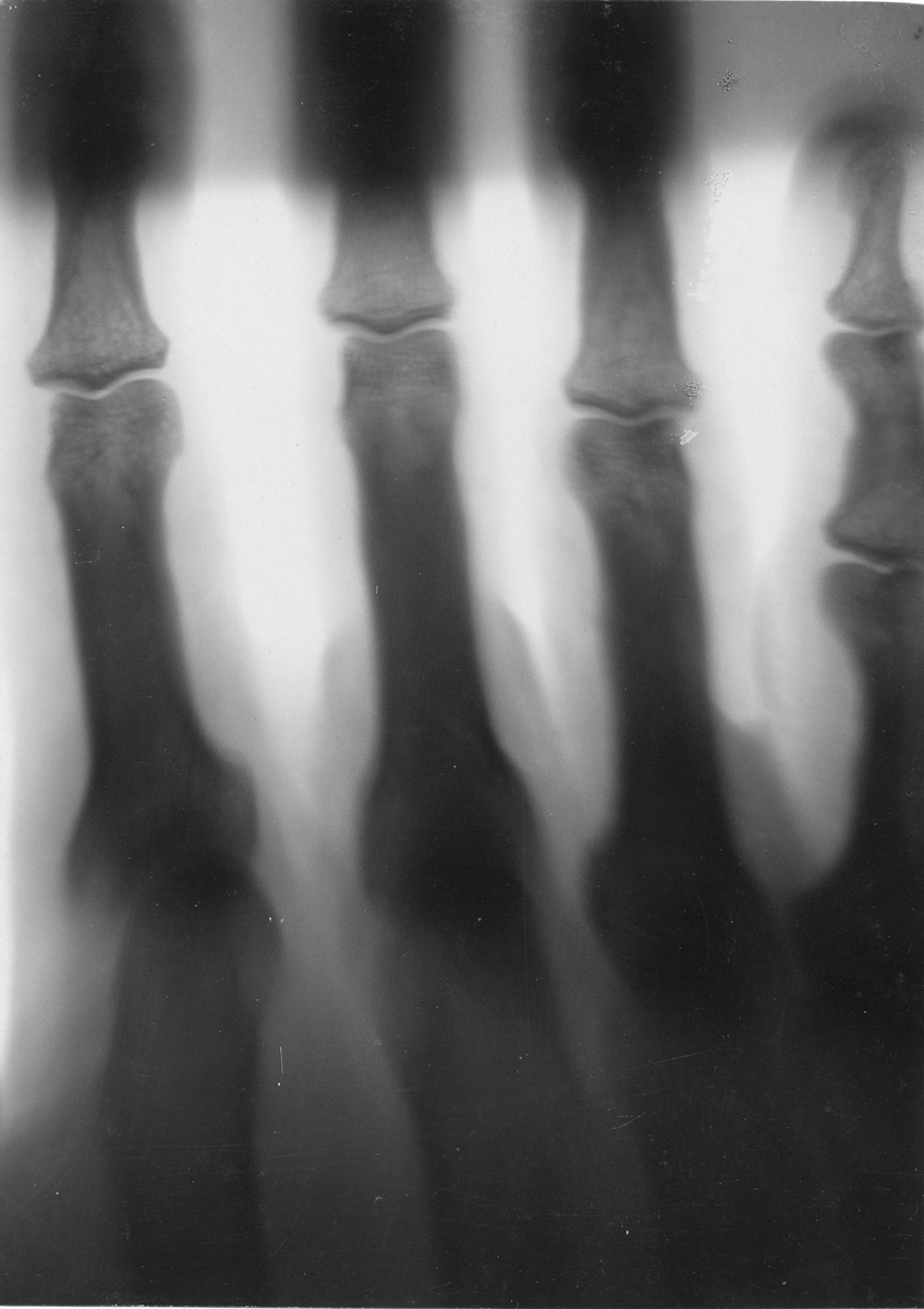 Fösök med x-strålar.Radiografi av lektor Zallanders hand, tagen i december 1896. Exponeringstid: 15 min med Crook's rör. Elkälla: Wimshersts handdrivna influensmaskin.