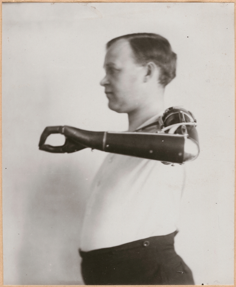 Fotografi från "Redogörelse för tillverkning vid Statens Järnvägars protesverkstad i Nässjö", 1932.
Visar armprotesens rörlighet och användbarhet.