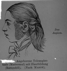 Medfødt Teleangiectasie (Modermal?) m. Haardannelse