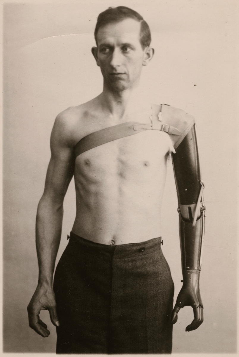 Fotografi från "Redogörelse för tillverkning vid Statens Järnvägars protesverkstad i Nässjö", 1932.
Visar armprotesens rörelseförmåga och användbarhet.
