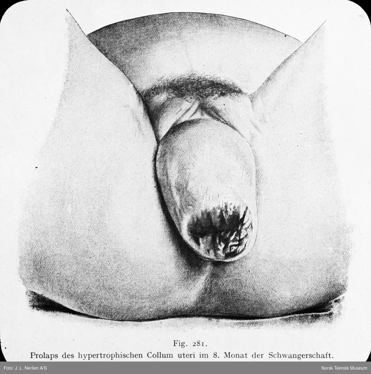 Avfotografert tegning av prolaps av kjønnsorganer, hypertrofisk collum uteri, i den 8. måned av svangerskapet