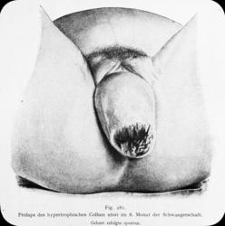 Avfotografert tegning av prolaps av kjønnsorganer, hypertrof